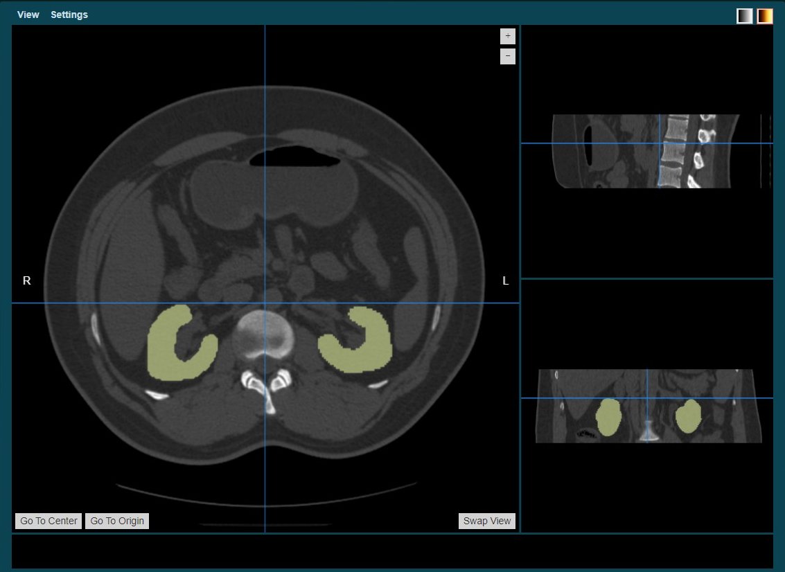 AIRA output: both kidneys segmented on an axial CT slice, with sagittal and coronal reformats for the radiologist to review
