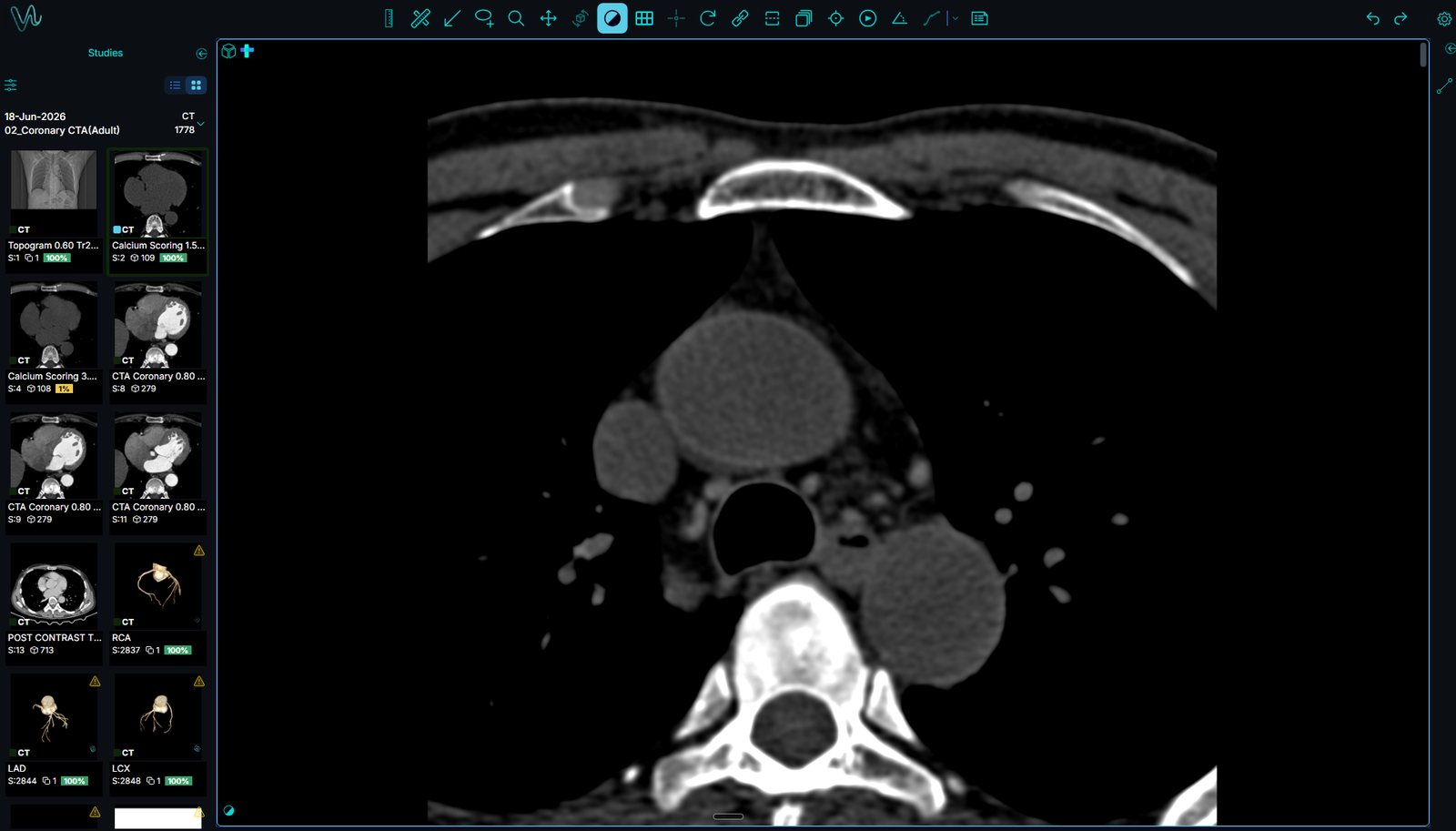 Vidus web DICOM viewer showing a coronary CTA study, with the series browser on the left and the reading toolbar across the top